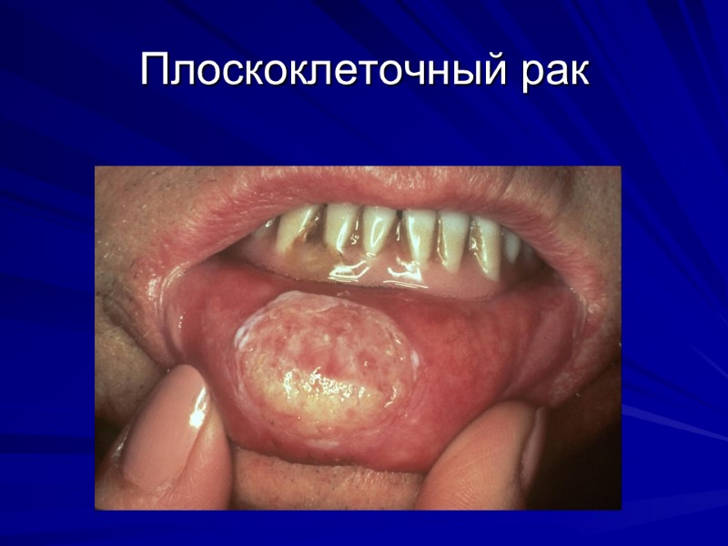 Плоскоклеточный рак